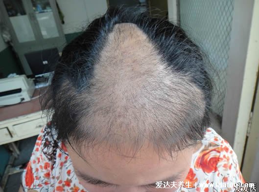 100種癬的種類與辨別圖片，體癬/手癬/頭癬/腳癬/股癬對照圖