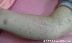急性白血病身上起了小紅點圖片(判斷慢性