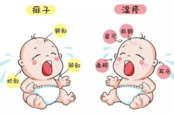 一張圖教你區別濕疹和痱子，從部位/癥狀/時間區分(濕疹時間長)