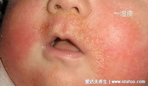 臉部過敏性皮炎圖片和癥狀，丘疹紅斑瘙癢避免抓癢(3種類型圖)