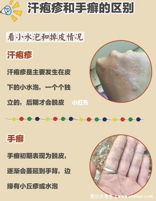 汗皰疹圖片初期癥狀圖片，有水皰干后脫皮有瘙癢灼燒感