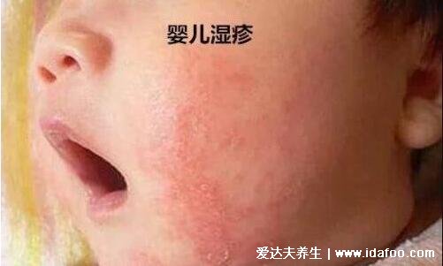 紅疹圖片初期癥狀圖片，麻疹/猩紅熱/蕁麻疹/濕疹/風疹合集
