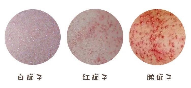 一張圖教你區別濕疹和痱子，從部位/癥狀/時間區分(濕疹時間長)