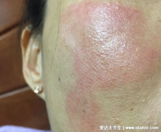 臉部過敏性皮炎圖片和癥狀，丘疹紅斑瘙癢避免抓癢(3種類型圖)