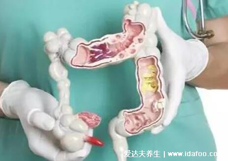 腸炎與腸癌最明顯的區別，注意腸炎腸癌癥狀(腸癌拉出來的大便圖)