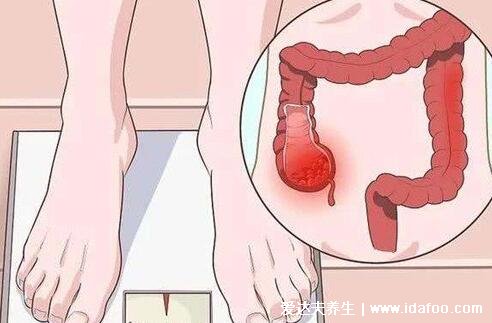腸炎與腸癌最明顯的區別，注意腸炎腸癌癥狀(腸癌拉出來的大便圖)