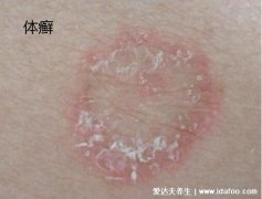 體癬病與濕疹的區別(歐布奧特曼100種卡片