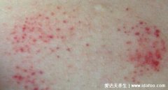 白血病是怎么引起的(紫紅色cmyk色值)