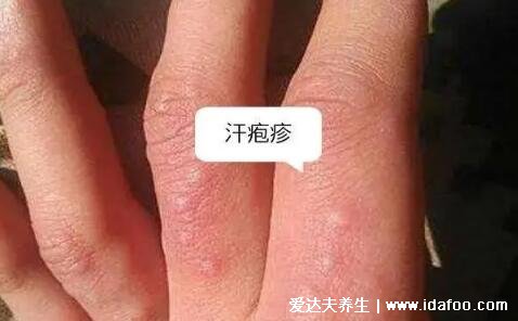 汗皰疹圖片初期癥狀圖片，有水皰干后脫皮有瘙癢灼燒感