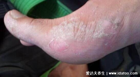 100種癬的種類與辨別圖片，體癬/手癬/頭癬/腳癬/股癬對照圖