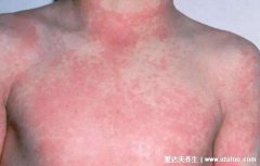 風疹和麻疹主要鑒別點(麻疹水痘手足口病