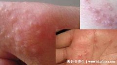 汗皰疹早期癥狀圖片(汗皰疹干了之后圖片