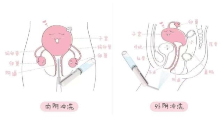 女人的兩瓣陰唇是不一樣大小的？女人兩片陰唇不一樣大嗎？[圖]