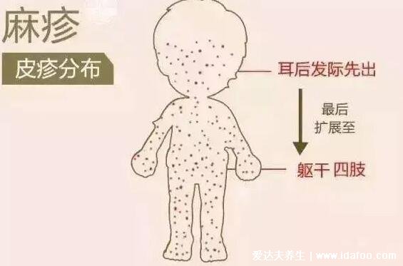 初期麻疹圖片和癥狀圖片，先發熱再出疹從發際開始(按壓褪色)