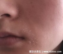 頭部脂溢性皮炎結痂(脂溢性皮炎 大塊頭