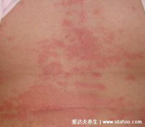 麻疹一般是什么原因(麻疹發疹前期癥狀有