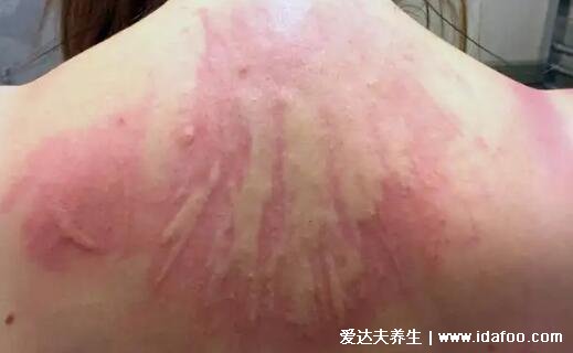 初期蕁麻疹圖片和癥狀，身上起紅疙瘩很癢的圖片(4種類型)