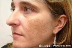 老年人血管斑塊消除最快的方法(45歲血管