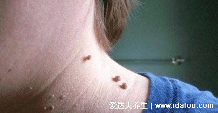 感染HPV病毒 就會惡變成宮頸癌嗎？造成宮頸癌的真正真相究竟是什么？