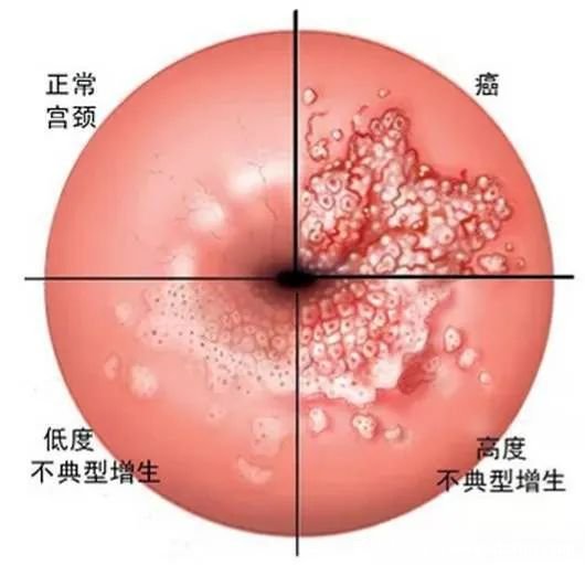 感染HPV病毒 就會惡變成宮頸癌嗎？造成宮頸癌的真正真相究竟是什么？