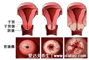 感染HPV病毒 就會惡變成宮頸癌嗎？造成宮頸癌的真正真相究竟是什么？