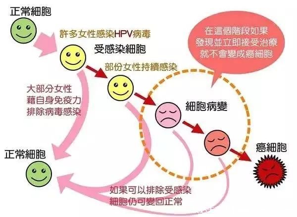 感染HPV病毒 就會惡變成宮頸癌嗎？造成宮頸癌的真正真相究竟是什么？