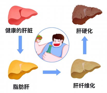 堅持三個護肝秘訣，有效改善肥胖性脂肪肝對身體的危害