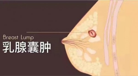 乳腺囊腫會變成乳腺癌嗎？