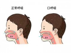 用嘴呼吸影響顏值(口呼吸對顏值的影響