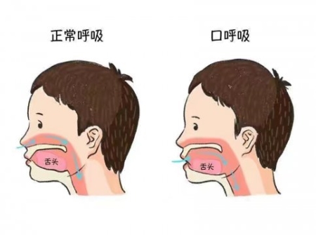 別讓口呼吸毀了孩子的顏值