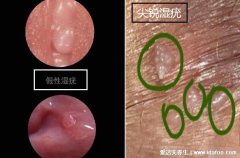 女性真假尖銳疣體區分圖片(真假尖銳疣體