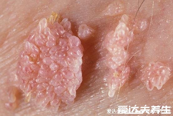女性假疣和真疣的區別圖片，看看尖濕銳尤典型圖片(真疣可X接觸傳染)