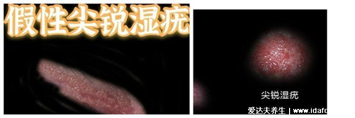 女性假疣和真疣的區別圖片，看看尖濕銳尤典型圖片(真疣可X接觸傳染)