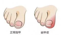 指甲脫落重新長過程需要注意什么(腳指甲