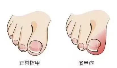 指甲總往肉里長反復發作怎么辦，該如何預防
