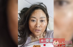 女子感染新冠高燒后滿臉發黑是怎么回事啊(新冠患者臉發黑)