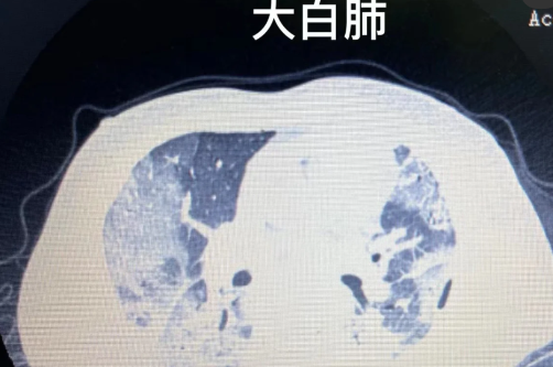 肺炎最嚴重是不是白肺3